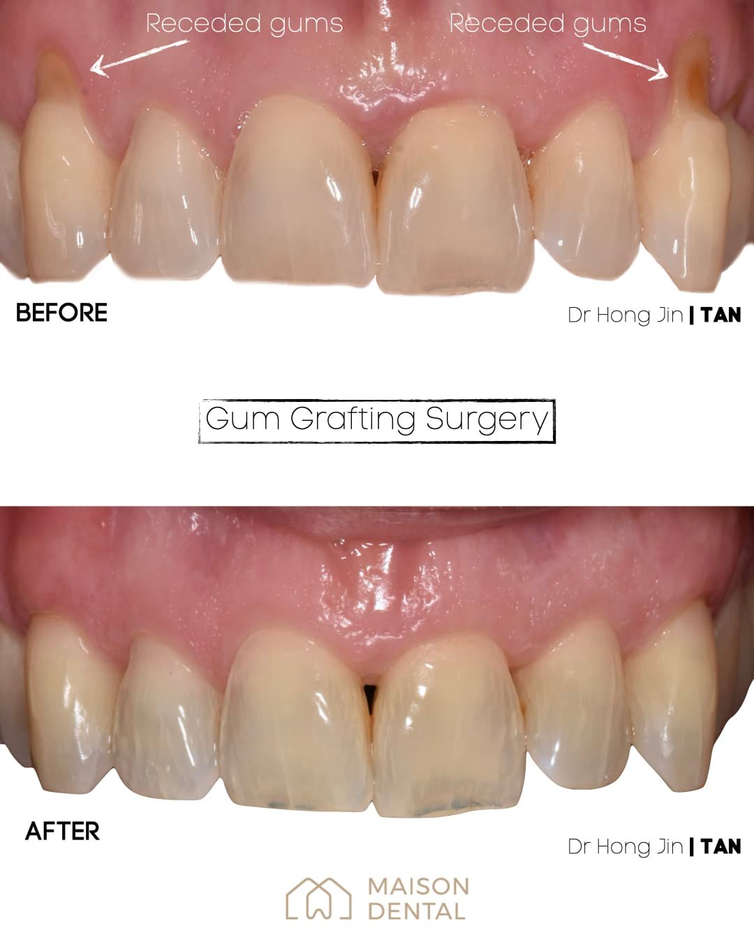 gum recession treatment kuala lumpur