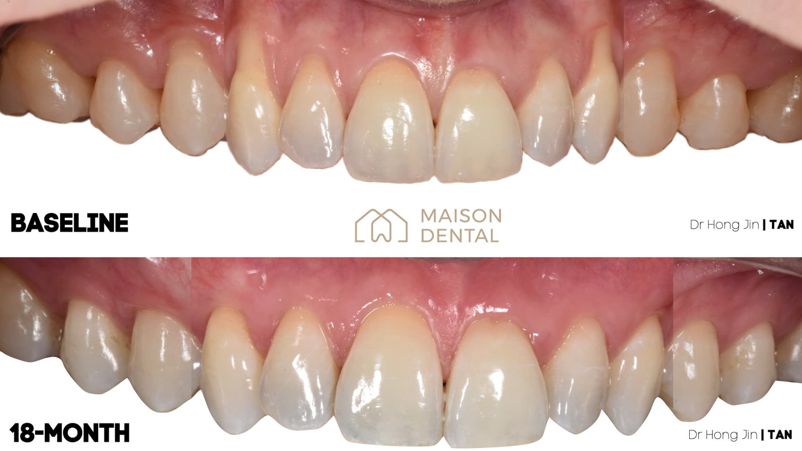 Gingival recession.001