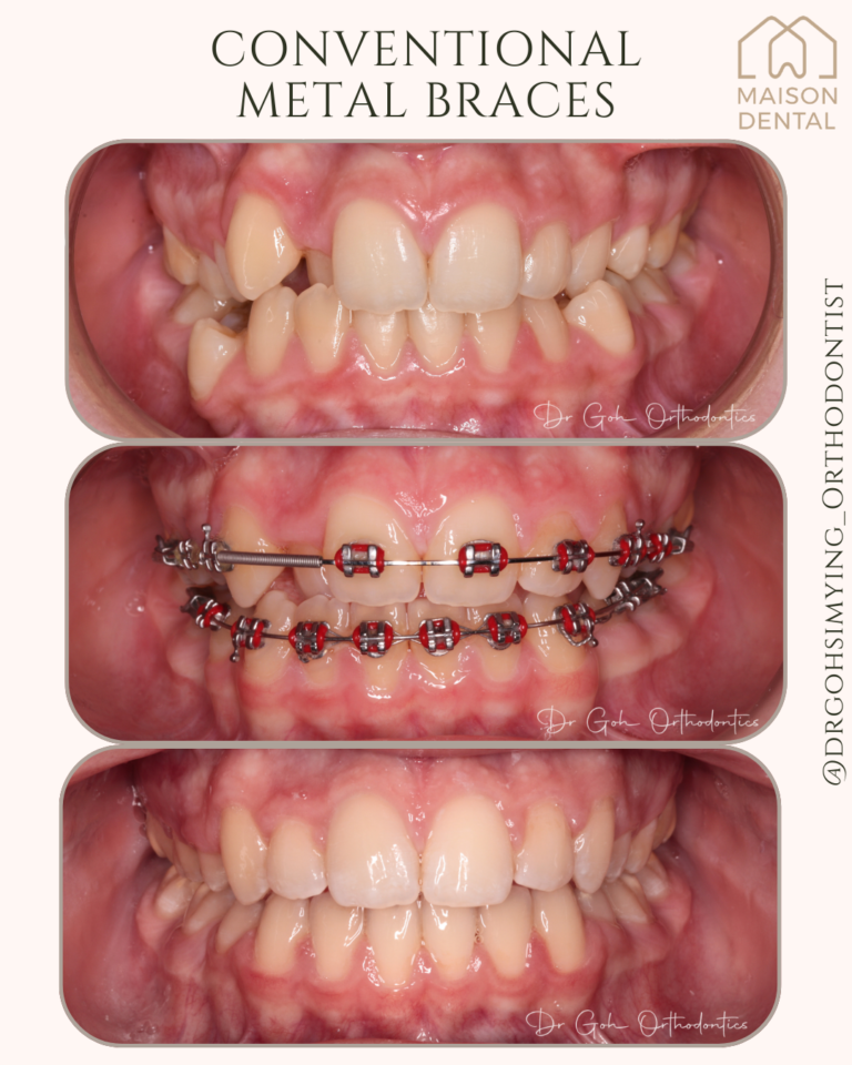 Braces Kuala Lumpur 1