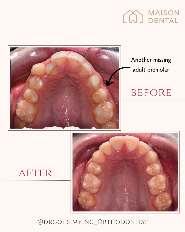 Braces Kuala Lumpur 3