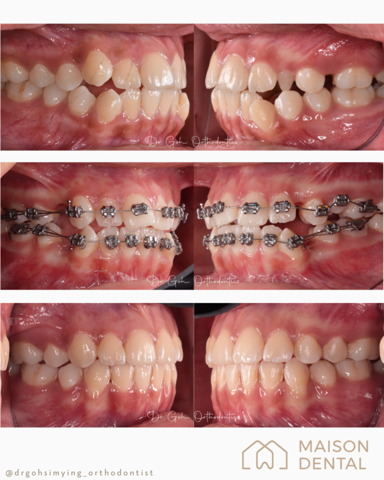 Braces Kuala Lumpur 3