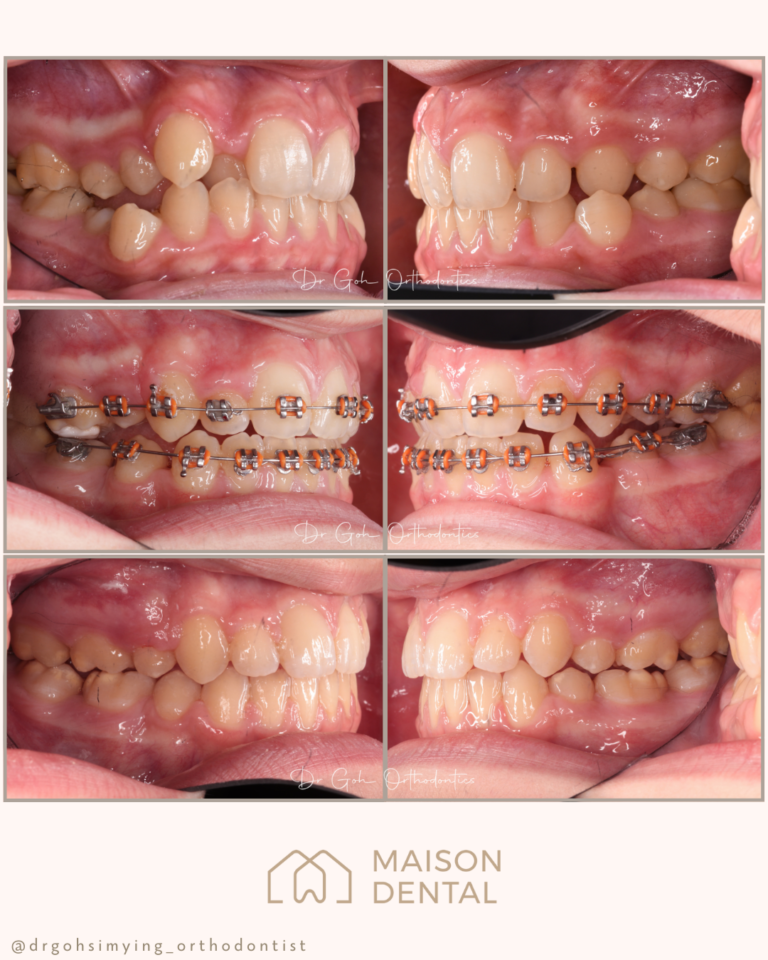 Braces Kuala Lumpur 4