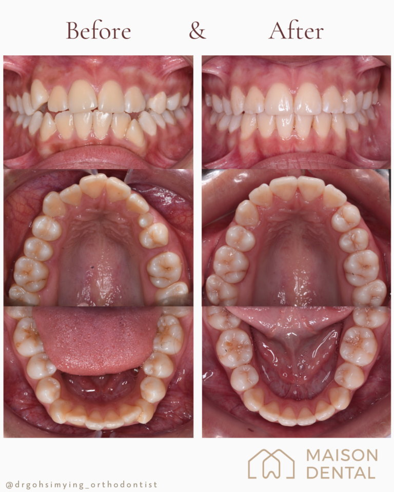 Braces Kuala Lumpur 4