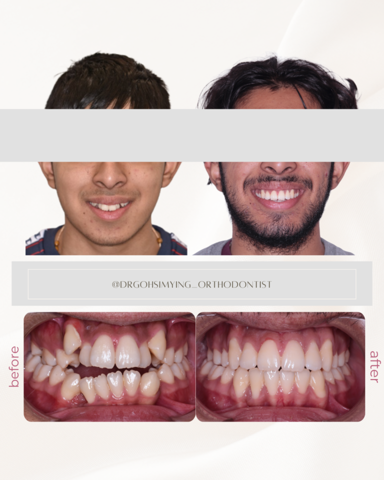 Braces Kuala Lumpur CF EO IO