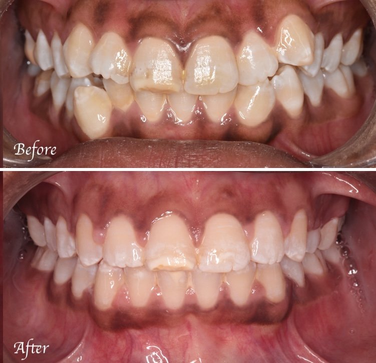 Braces Kuala Lumpur Case 1 copy