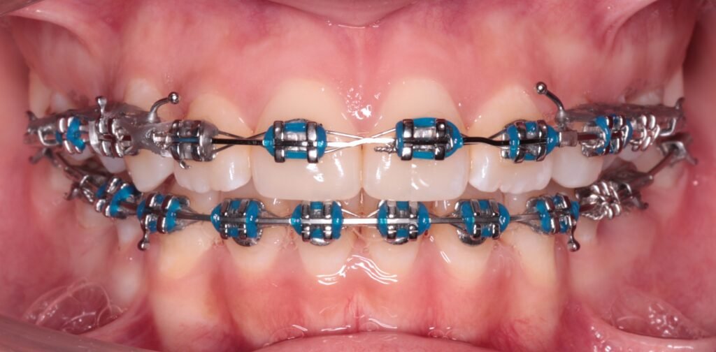 braces kuala lumpur