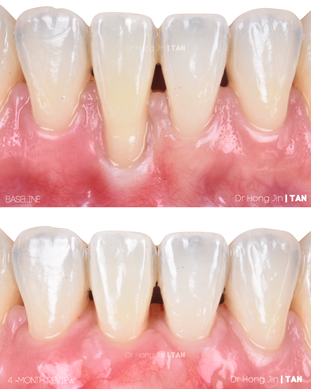 Gum Dental Specialist lower front teeth soft tissue grafting