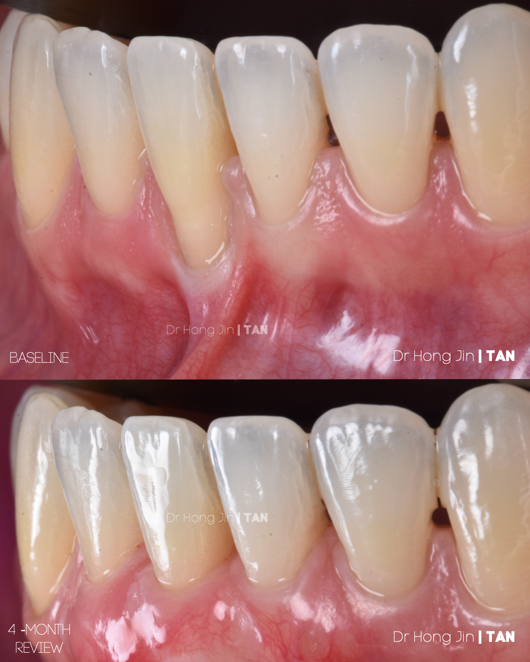 Gum Dental Specialist soft tissue grafting eliminating high frenum attachment