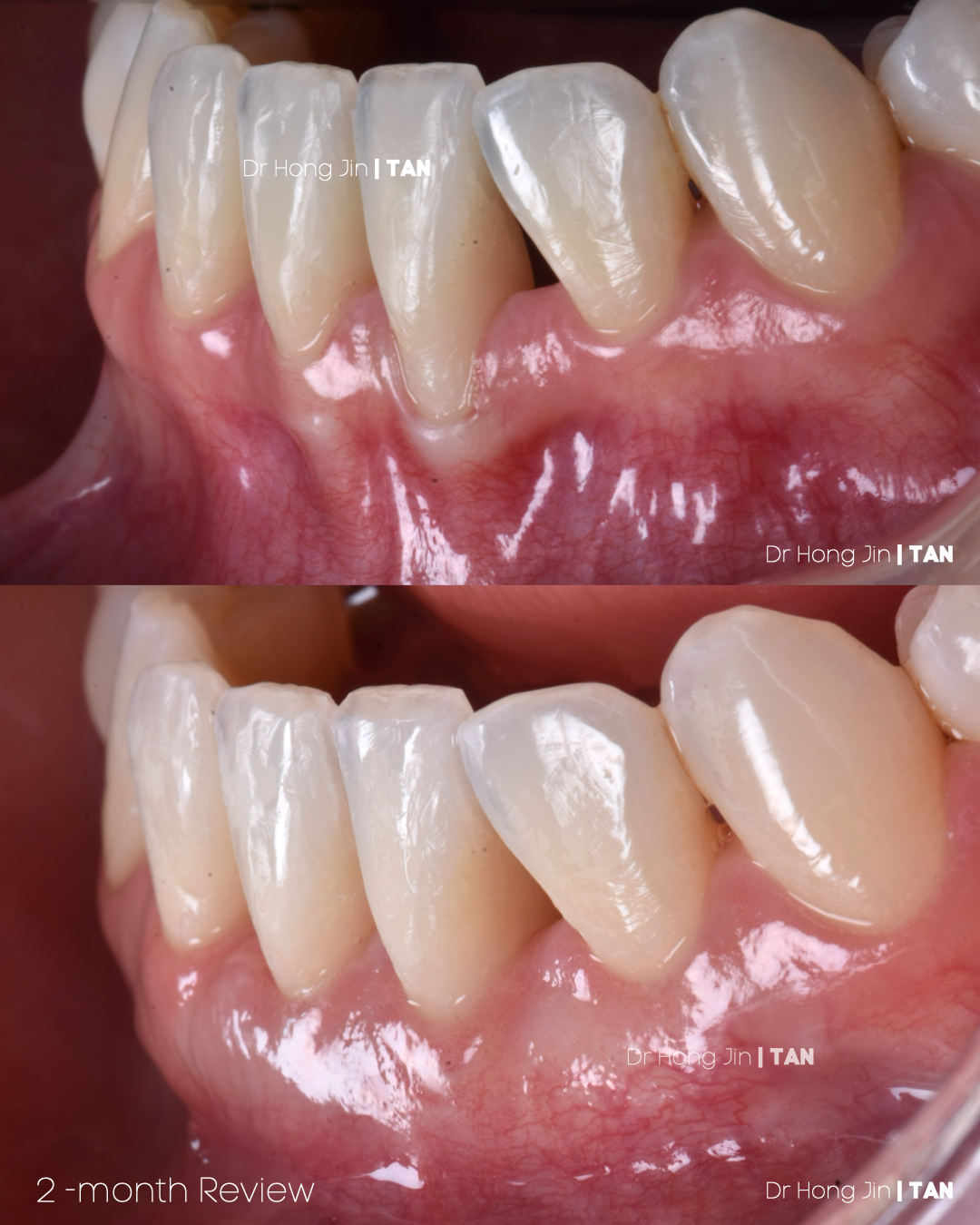 Gum Dental Specialist orthodontic recession soft tissue grafting